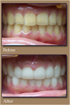 teeth-whitening